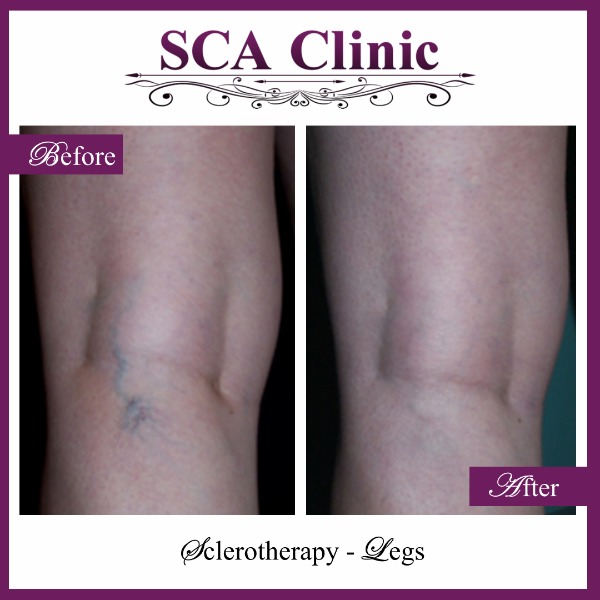 Sclerotherapy - Legs